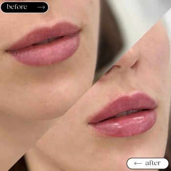  

 

 

 

 ’єкціїКраси

 

 