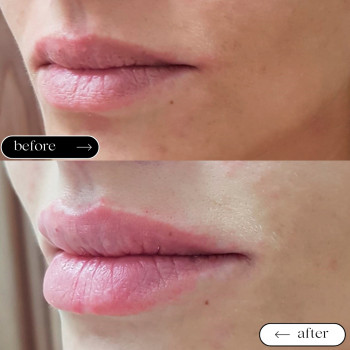  

 

 

 

 ’єкціїКраси

 

 