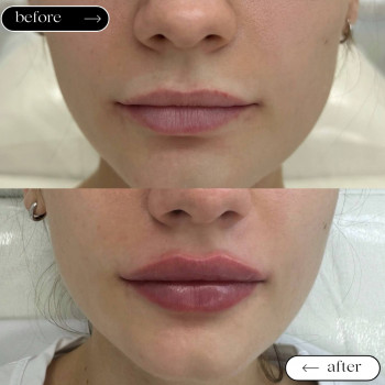  

 

 

 

 ’єкціїКраси

 

 