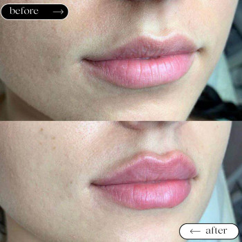  

 

 

 

 ’єкціїКраси

 

 