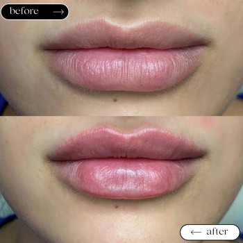  

 

 

 

 ’єкціїКраси

 

 