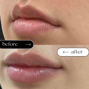  

 

 

 

 ’єкціїКраси

 

 