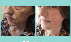 SMAS - Ulthera system: безоперационная подтяжка Косметолог-естетист Ирина Валерьевна Одеса