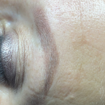 Через місяць після першої процедури