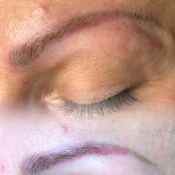 Перша процедура, фото одразу після