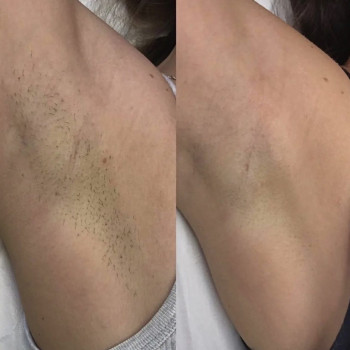 Лазерна епіляція: комплекс XS -  пахви + глибоке бікіні або пахви + гомілки
                    Косметологический центр Монолазер Киев