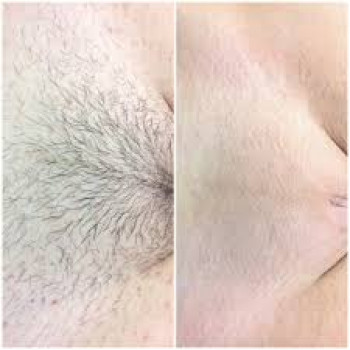 Лазерна епіляція: комплекс XS -  пахви + глибоке бікіні або пахви + гомілки
                    Косметологический центр Монолазер Киев