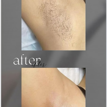 Восковая депиляция
                    Мастер депиляции  Одесса