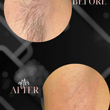 Восковая депиляция
                    Мастер депиляции  Одесса