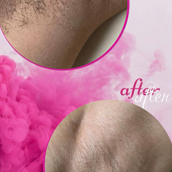 Восковая депиляция
                    Мастер депиляции  Одесса