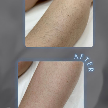 Восковая депиляция
                    Мастер депиляции  Одесса