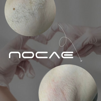 Восковая депиляция
                    Мастер депиляции  Одесса