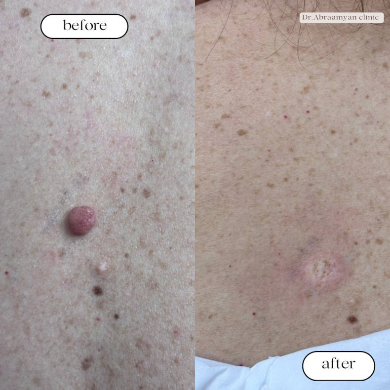 Одразу після видалення родимки, фото - Косметологічний центр Dr.  Abraamyan Clinic