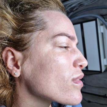 Ферментотерапия с использованием LED лампы. Экзосомальная ферментотерапия.
                    Косметолог-эстетист Влада Харьков