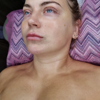 Ферментотерапия с использованием LED лампы. Экзосомальная ферментотерапия.
                    Косметолог-эстетист Влада Харьков