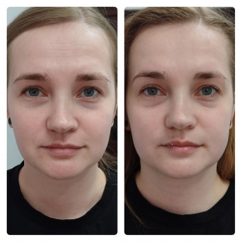 Буккальний масаж
                    Косметолог Інга Хмельницкий