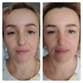 Буккальний масаж
                    Косметолог Інга Хмельницкий