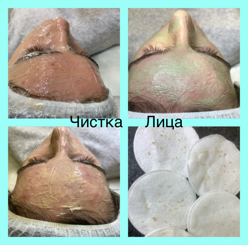 Чистка обличчя механічна, фото - Мастер по пирсингу Татьяна Ананьева
