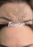 💉 АКЦІЯ НА БОТОКС — ЛОБ + МІЖБРІВКА 💎 Косметолог Валентина Черкаси