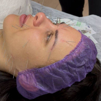 Лифтинг лица ( Сухая игла )