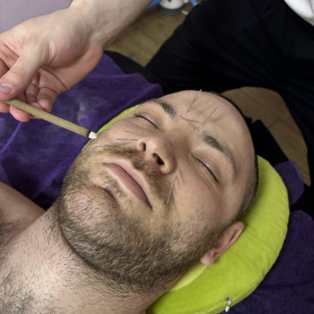 Ліфтинг обличчя сухі голки.
                    Масажист Михаил Чорноморськ