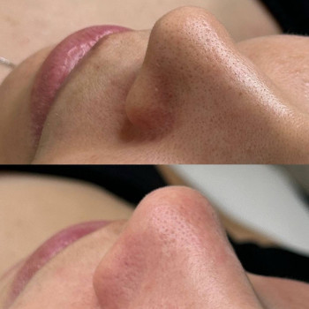 Комбінована чистка обличчя