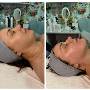 Масаж обличчя + карбоксітерапія