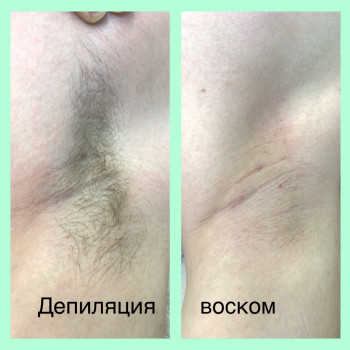 Депіляція воском