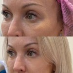 Пілінг для повік Дерматолог косметолог Нелли Київ