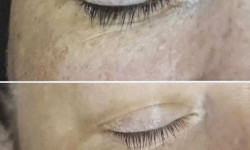 Экзосомальный пилинг   EXOPEEL PEELING SYSTEM Врач-косметолог Майя Киев