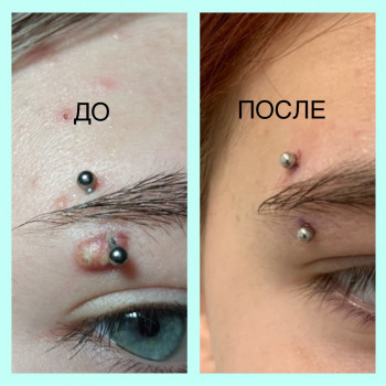 Лікування грануляціі травмованого прокола брови