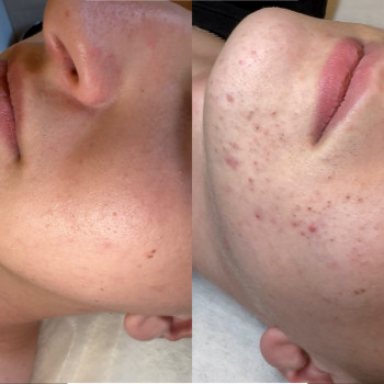  #лікуванняакнестрий #косметологстрий #чисткаобличчястрий