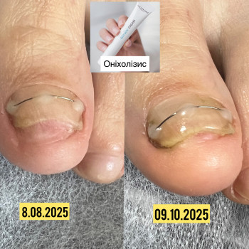 В домашньому догляді використовували ONYGEN