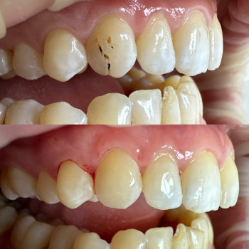 Лікування карієсу 1.3 зуба 
До/після