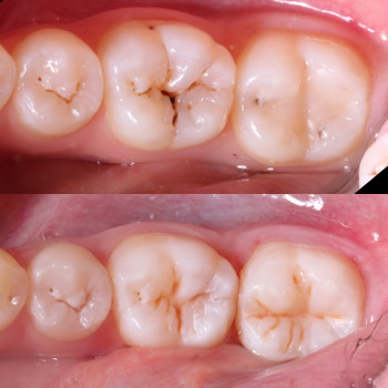 Лікування карієсу
До/після