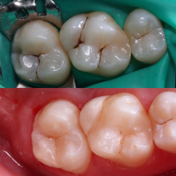 Лікування карієсу
До/після