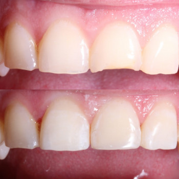 Відновлення ріжучого краю центрального різця