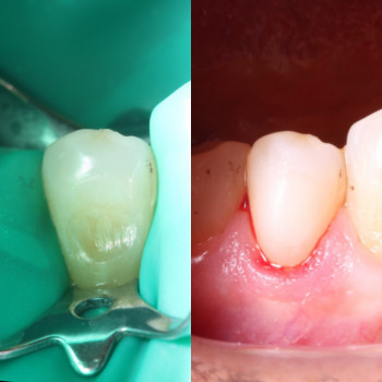 Лікування клиновидного дефекту