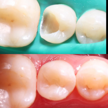 Лікування карієсу.
На фото зуб очищений від карієсу та після відновлений за допомогою фотополімерної...