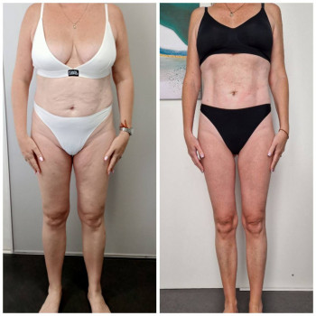 Результат після проходження курсу 10 процеду