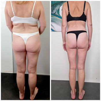 Результат після проходження курсу 10 процеду