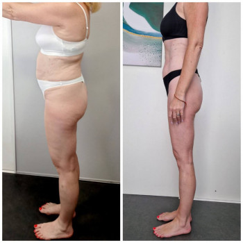 Результат після проходження курсу 10 процеду