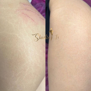 Микронидлинг - удаление расстяжек
                    Массажный салон Студия аппаратних массажей Studio 18 Днепр