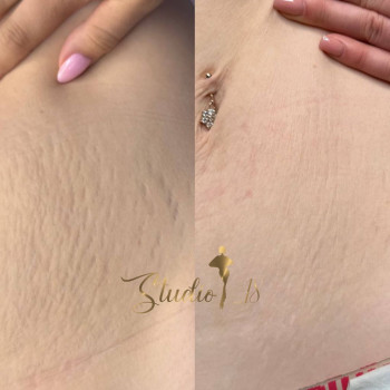 Микронидлинг - удаление расстяжек
                    Массажный салон Студия аппаратних массажей Studio 18 Днепр