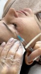 Плазмотерапія Косметолог-инъекционист Євгенія Ивано-Франковск