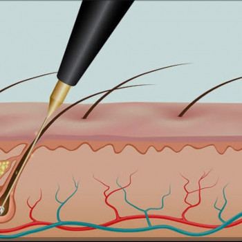 Показаний наглядний метод, видалення волосянної фолікули за допомогою голки-електрода.