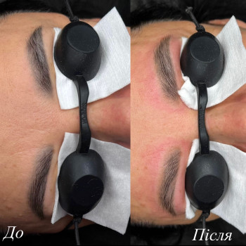 Лазерне видалення