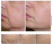 Мікроголковий RF ліфтинг обличчя Косметолог  Киев