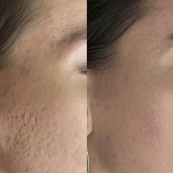 Карбоновый пилинг возвращает свежесть и молодость.
                    Мастер перманентного макияжа Людмила Черноморск