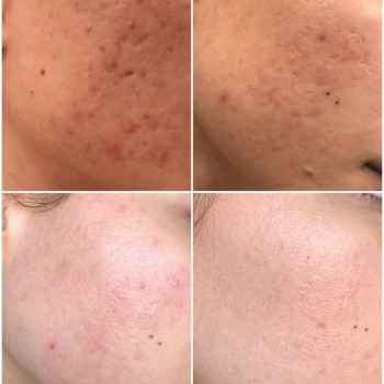 Карбоновый пилинг возвращает свежесть и молодость.
                    Мастер перманентного макияжа Людмила Черноморск